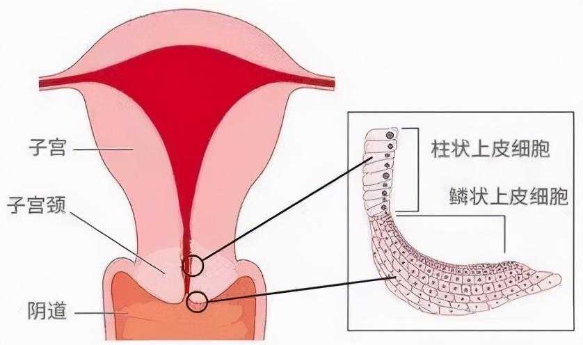 锥切病理cin1需要进一步治疗吗_宫颈锥切手术费用