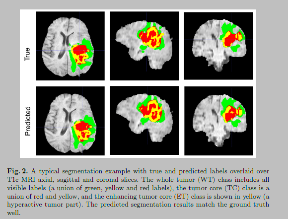 MICCAI2018-BraTSfirst-3D MRI brain tumor segmentation using autoencoder regularization