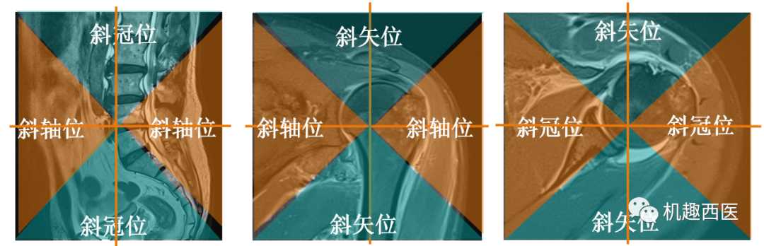 “左”还是“右”，斜方位磁共振成像不要“方”