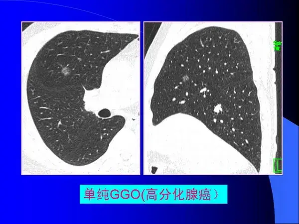 肺内基本病变的MSCT观察与分析