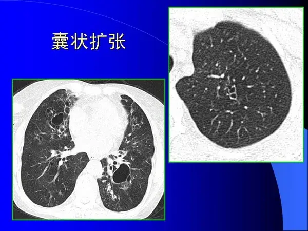 肺内基本病变的MSCT观察与分析