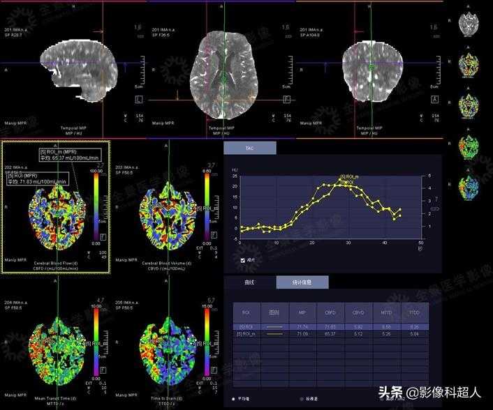 MSCT一站式全脑灌注与动态血管成像评估