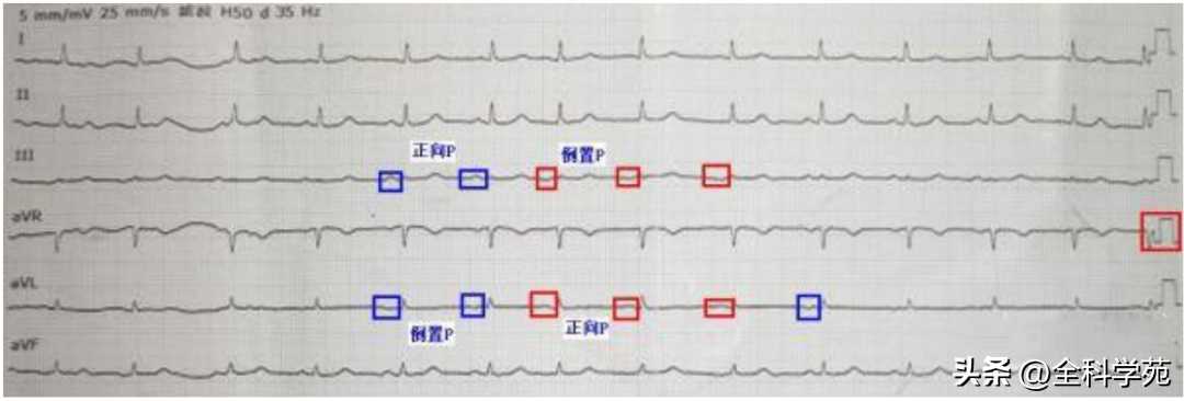 心电图理论笔记15： 窦性P波：正常与异常