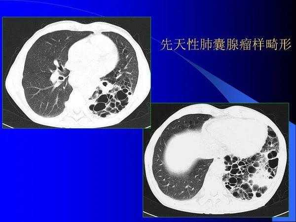 肺内基本病变的MSCT观察与分析