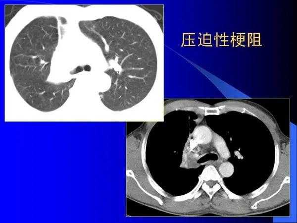 肺内基本病变的MSCT观察与分析