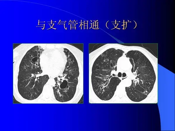 肺内基本病变的MSCT观察与分析