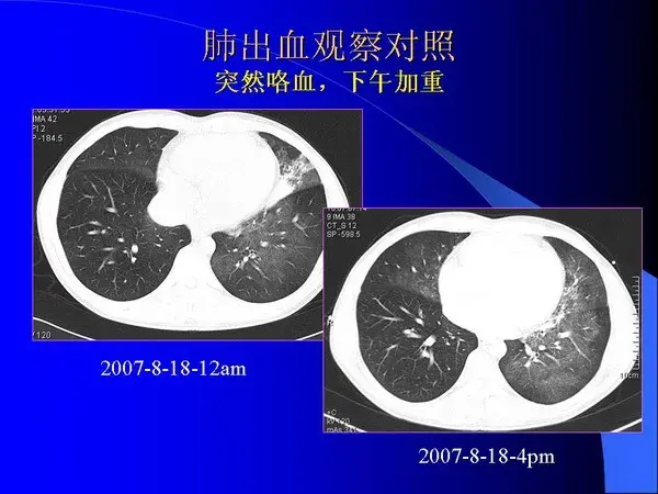 肺内基本病变的MSCT观察与分析