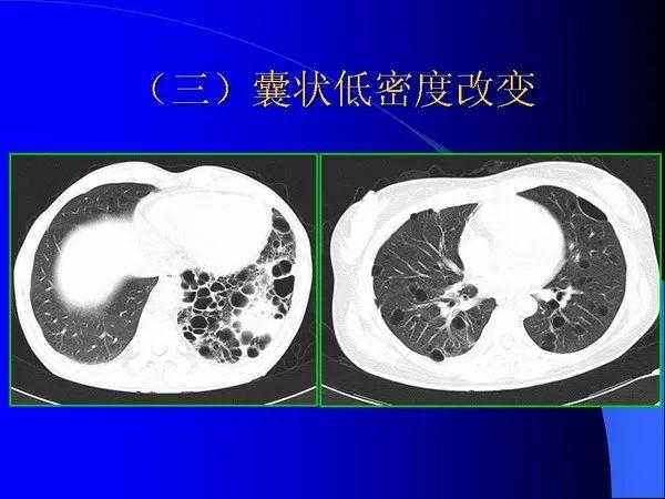 肺内基本病变的MSCT观察与分析