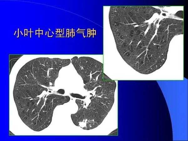 肺内基本病变的MSCT观察与分析