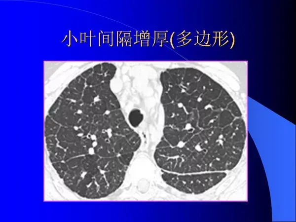 肺内基本病变的MSCT观察与分析