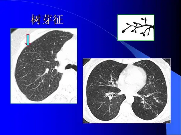 肺内基本病变的MSCT观察与分析