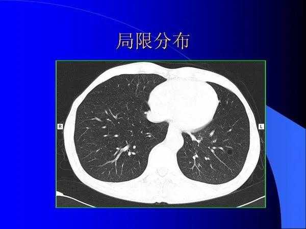 肺内基本病变的MSCT观察与分析