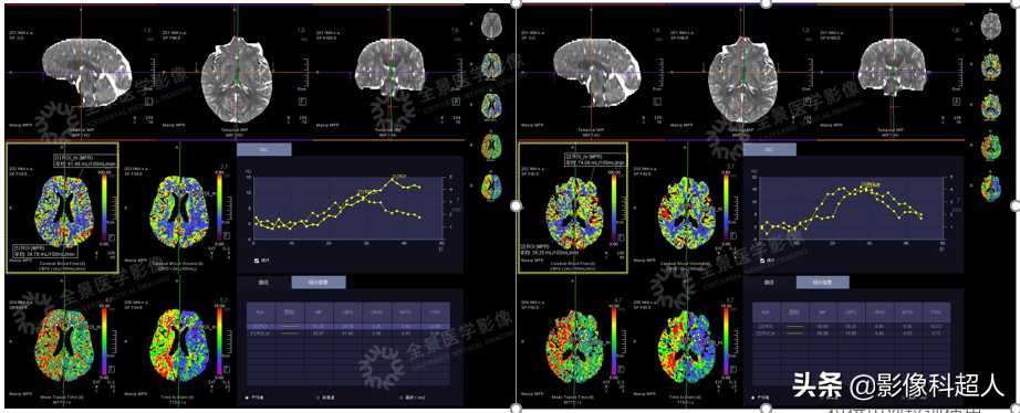 MSCT一站式全脑灌注与动态血管成像评估