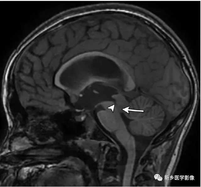 25种大脑中线处常见疾病