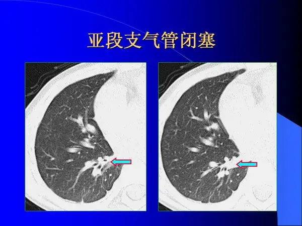 肺内基本病变的MSCT观察与分析