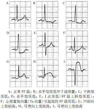 新版《心电图测量技术指南》，心内科医生都在转！