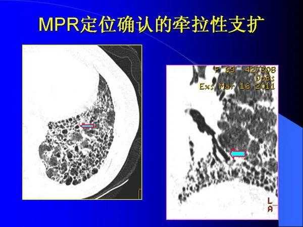 肺内基本病变的MSCT观察与分析