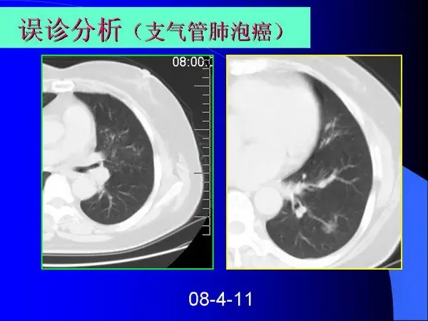 肺内基本病变的MSCT观察与分析