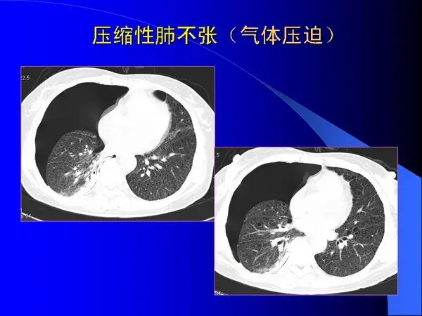 肺内基本病变的MSCT观察与分析