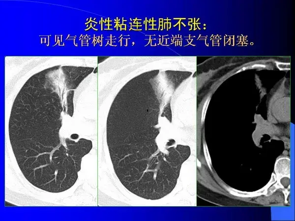 肺内基本病变的MSCT观察与分析