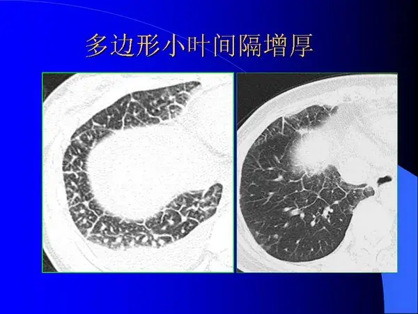 肺内基本病变的MSCT观察与分析