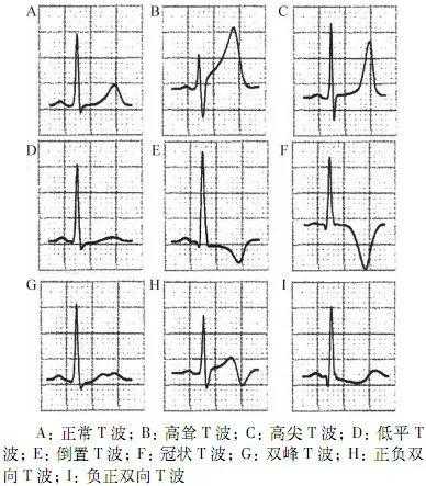 新版《心电图测量技术指南》，心内科医生都在转！