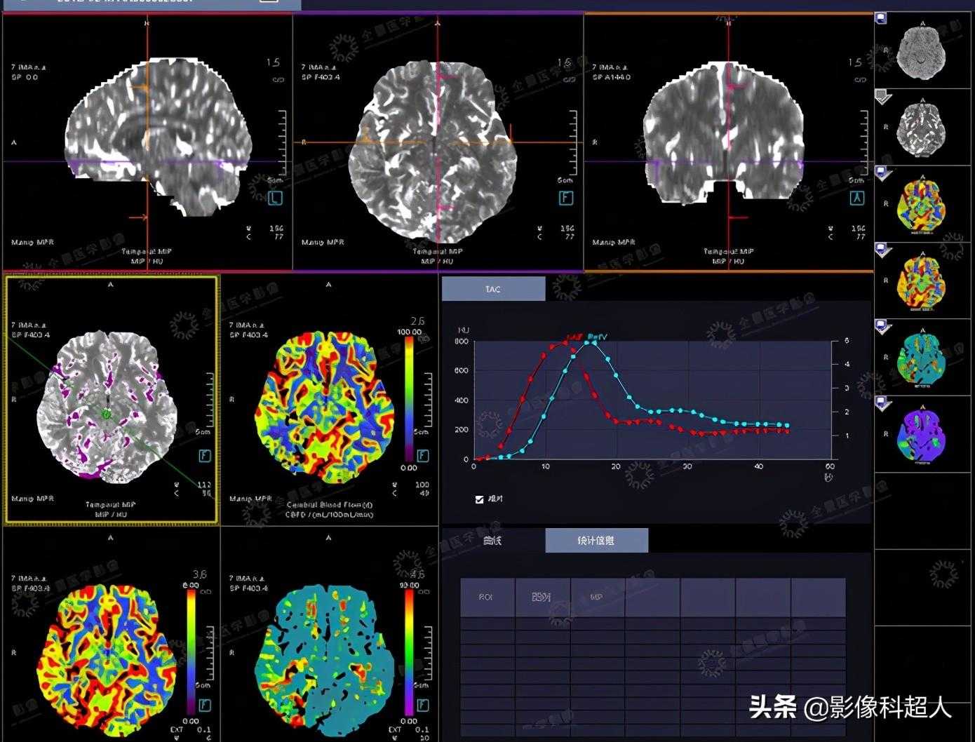 MSCT一站式全脑灌注与动态血管成像评估
