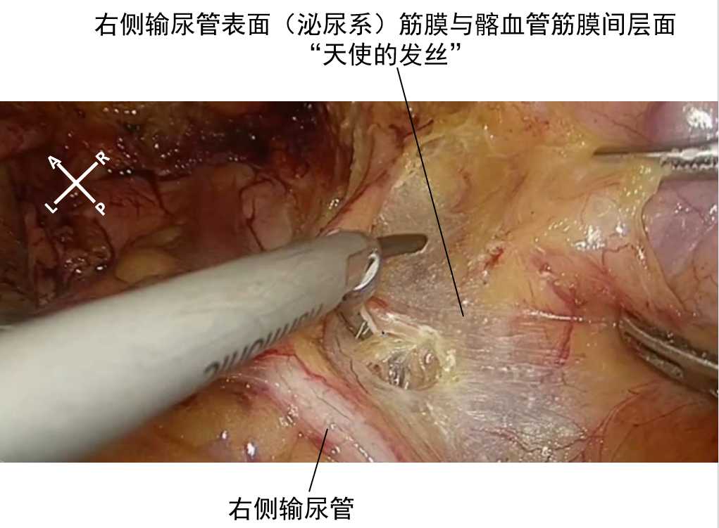 腹盆腔筋膜间层面解剖