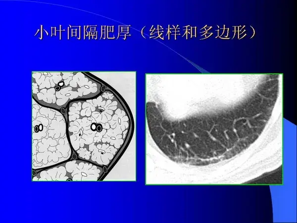 肺内基本病变的MSCT观察与分析