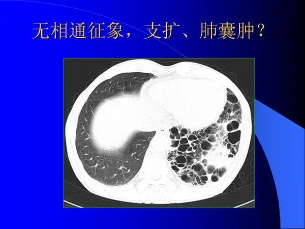 肺内基本病变的MSCT观察与分析