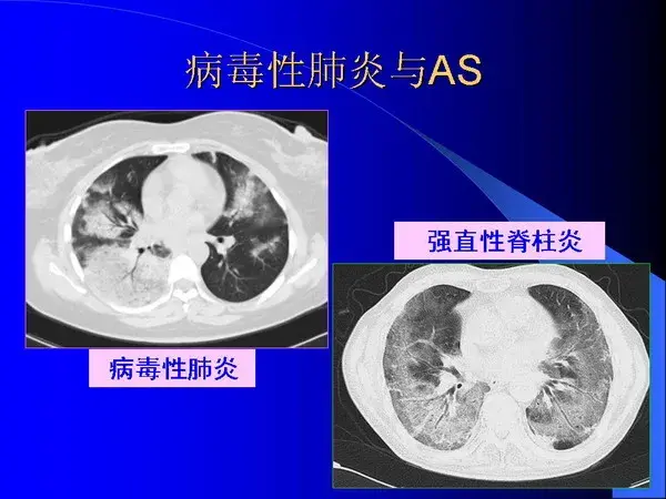 肺内基本病变的MSCT观察与分析