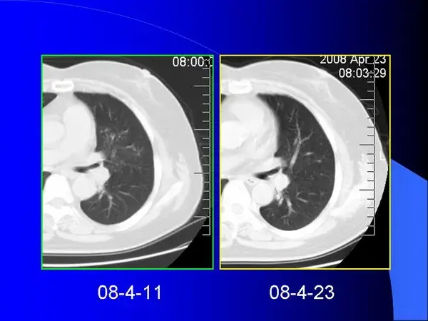 肺内基本病变的MSCT观察与分析