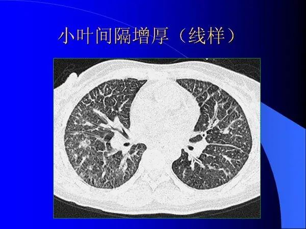 肺内基本病变的MSCT观察与分析