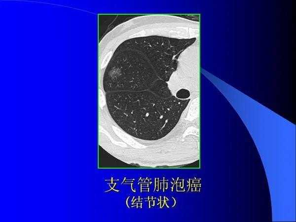 肺内基本病变的MSCT观察与分析