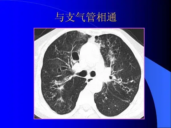 肺内基本病变的MSCT观察与分析