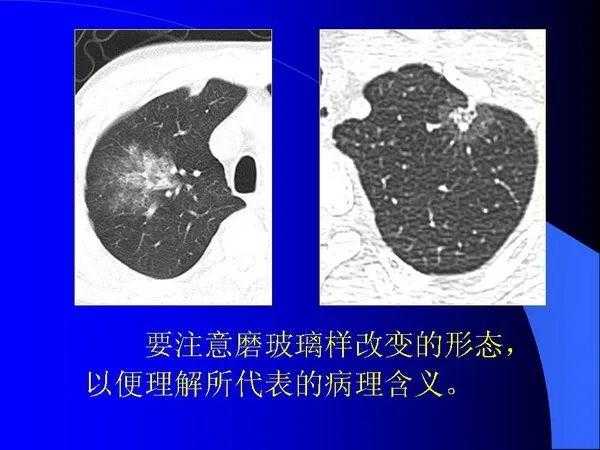 肺内基本病变的MSCT观察与分析