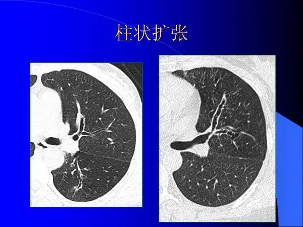 肺内基本病变的MSCT观察与分析