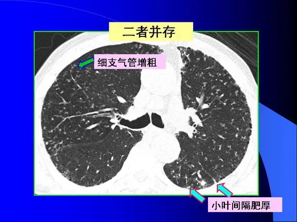 肺内基本病变的MSCT观察与分析