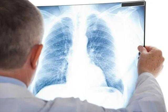 不敢直视的体检报告——肺小结节