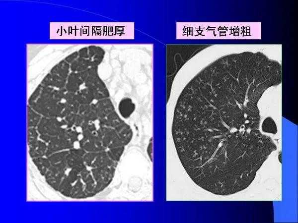 肺内基本病变的MSCT观察与分析