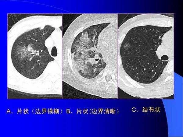 肺内基本病变的MSCT观察与分析