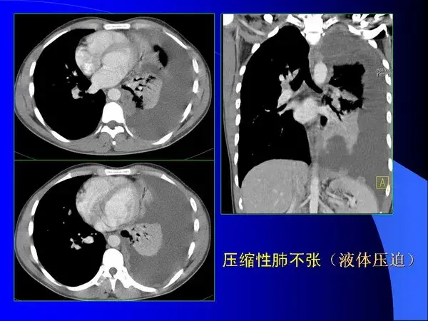 肺内基本病变的MSCT观察与分析