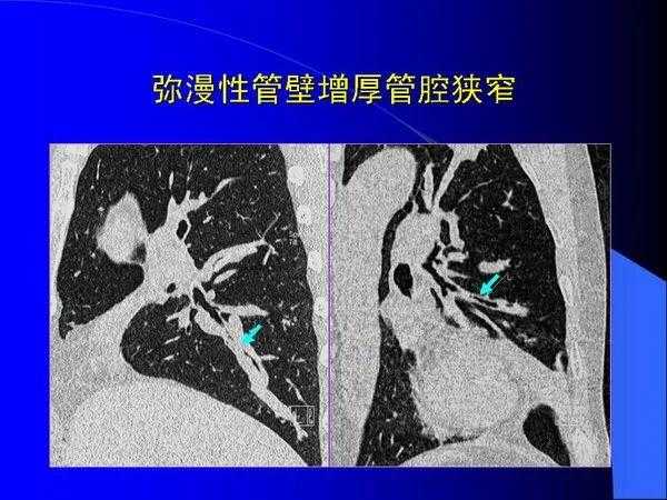 肺内基本病变的MSCT观察与分析