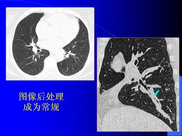 肺内基本病变的MSCT观察与分析