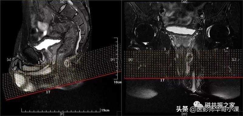 磁共振直肠MRI及肛周MRI扫描技术