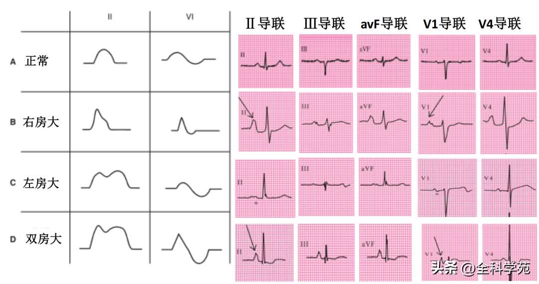 心电图理论笔记15： 窦性P波：正常与异常