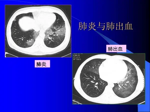 肺内基本病变的MSCT观察与分析