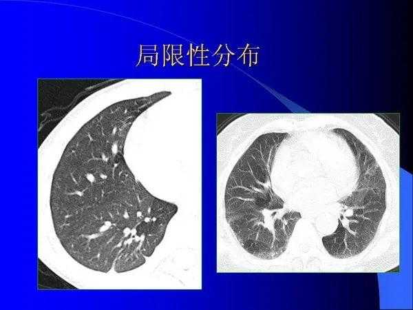 肺内基本病变的MSCT观察与分析