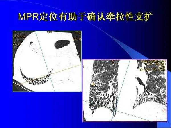 肺内基本病变的MSCT观察与分析