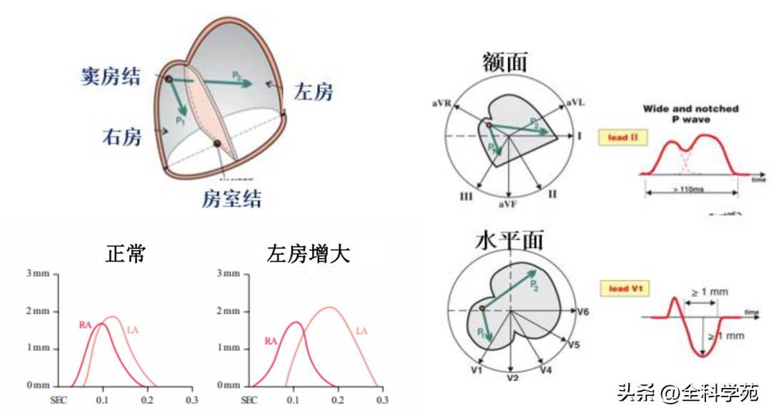 心电图理论笔记15： 窦性P波：正常与异常